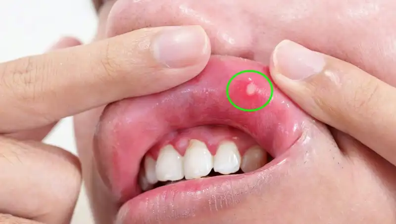B Vitaminleri Eksikliği: Vücudun Alarm Verdiği 5 Belirtiyi Kaçırmayın!