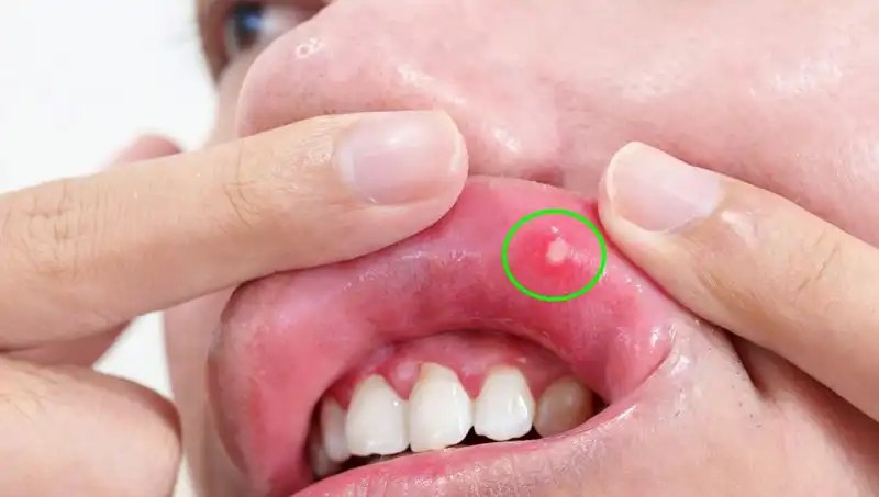 Kanserin Sessiz Uyarısı: Dili Alınmak Zorunda Kaldı