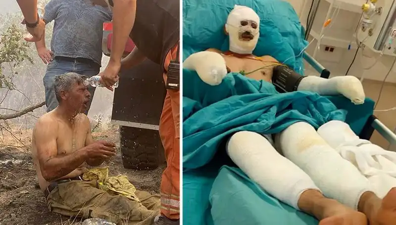 Yanıyorum Diyerek Feryat Etti, Orman İşçisinin Durumu Gündem Olmayı Sürdürüyor